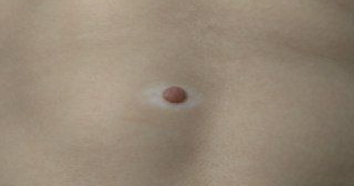 Nevus Halo (Nevus de Sutton): Causas, Conexão com Vitiligo & Quando se ...