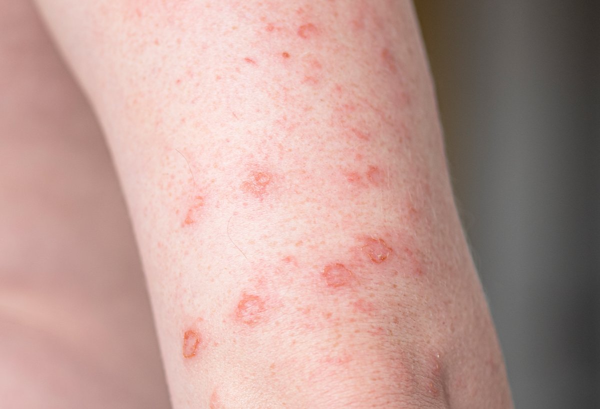 突然新しいほくろが現れましたか?心配すべき時はいつ? | Skinscannerブログ