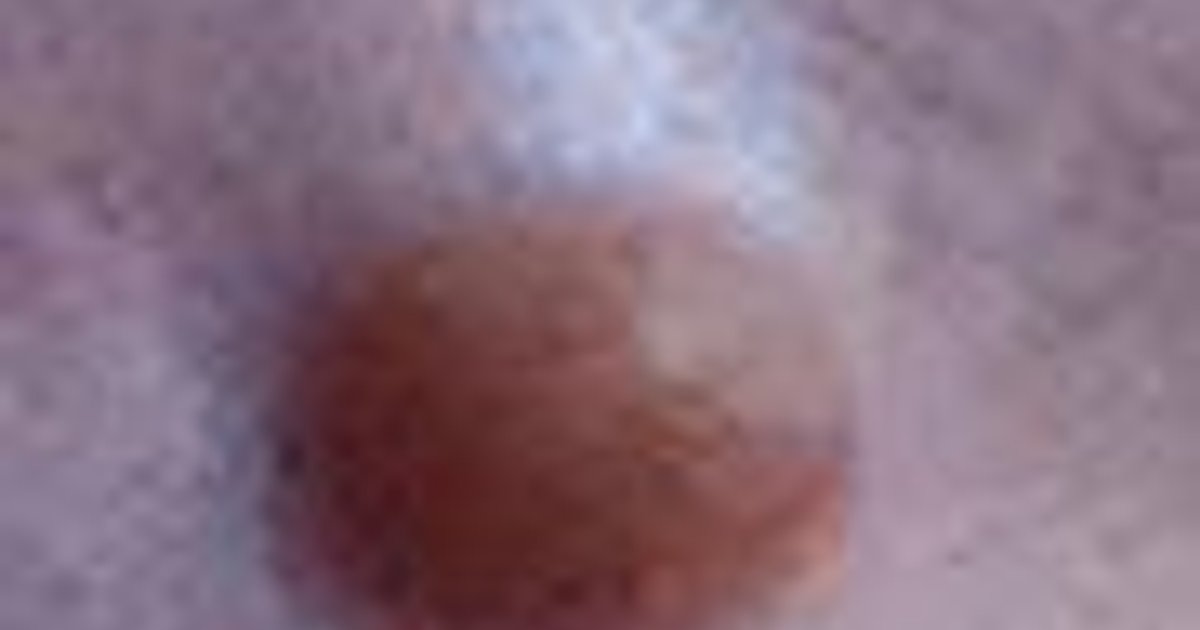 Spitz Nevus: Diagnosis, Melanoma Mimicry & Management in Children and ...